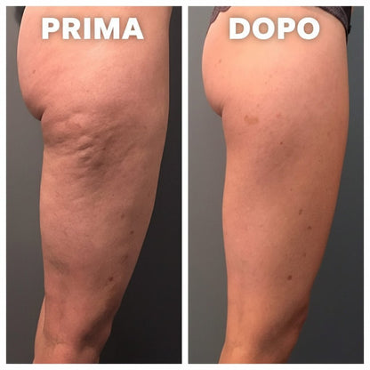 Massaggiatore Elettrico Anti Cellulite - Vorien